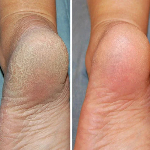 Silicone Spa Socks – Intensive Care for Cracked and Tired Feet