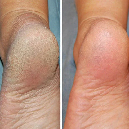 Silicone Spa Socks – Intensive Care for Cracked and Tired Feet